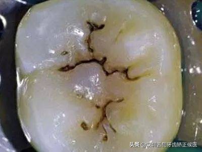 牙齿上有黑线怎么办,牙齿黑线的治疗视频