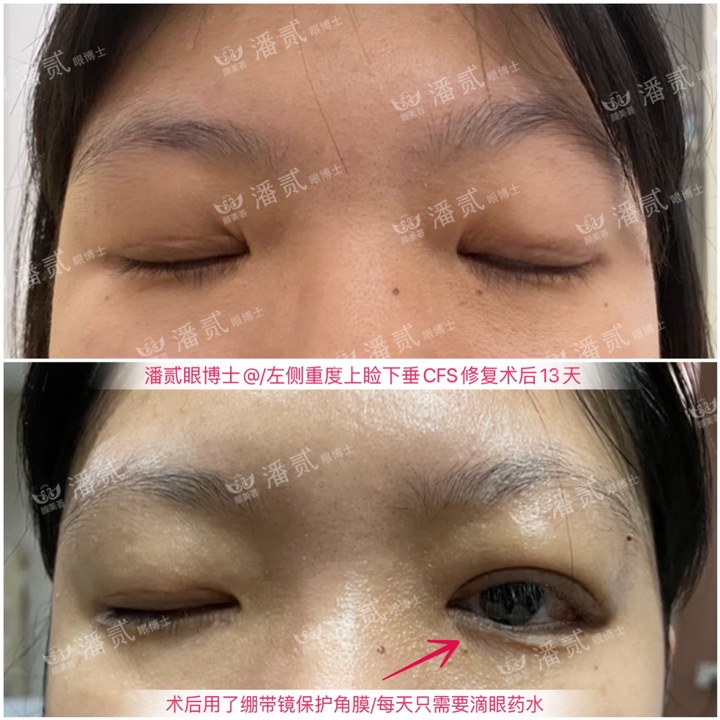 重度上睑下垂术后为什么闭不上眼睛？闭眼不全怎么护理好？