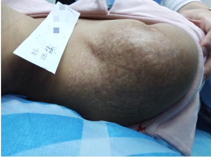 女婴右肩斑块连结混合型血管瘤生长迅速
