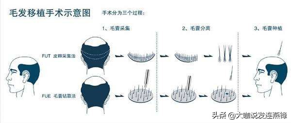 从后脑勺往头顶慢慢脱发,额前脱发植发效果如何