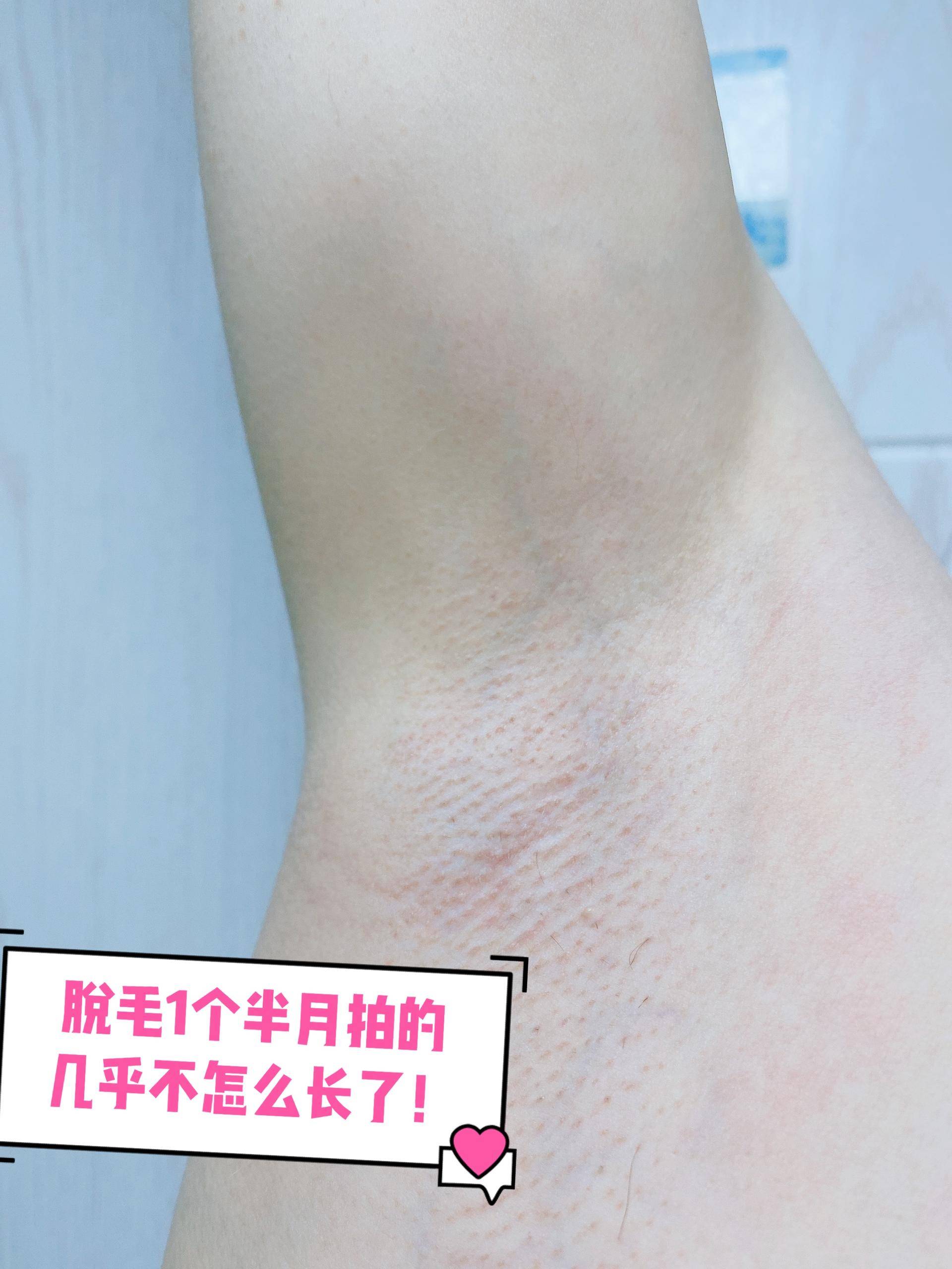 ulike蓝宝石脱毛仪真的好用吗,partyplus脱毛仪好用吗