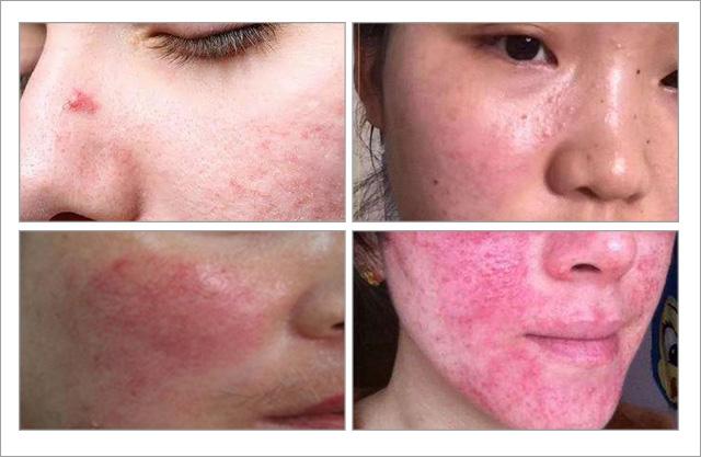 根除脸上螨虫的简单方法,螨虫在脸上如何彻底消除