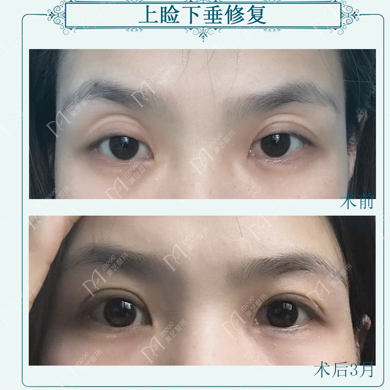 三眼皮显老气吗,三眼皮真的很好看吗