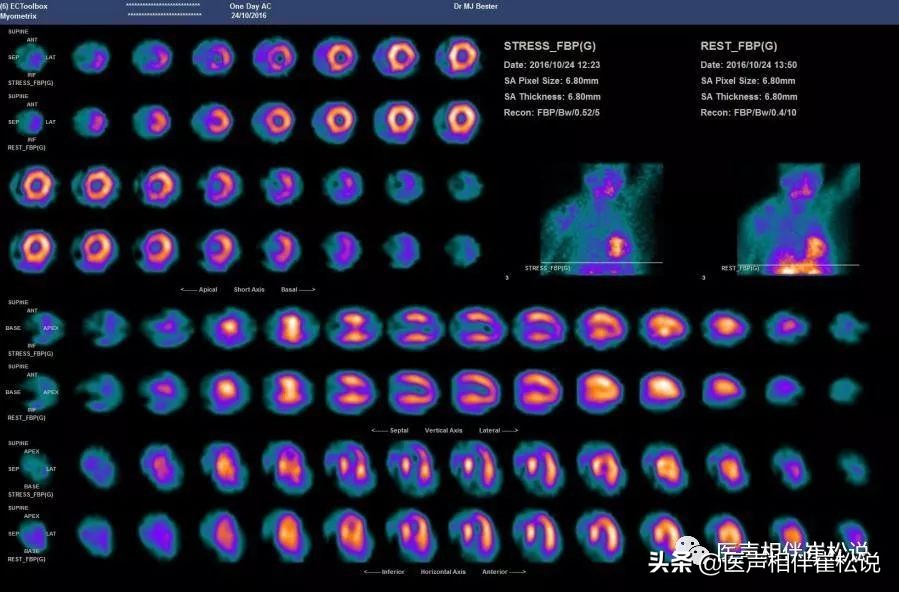 心电图上t波改变啥意思,心电图上t波改变