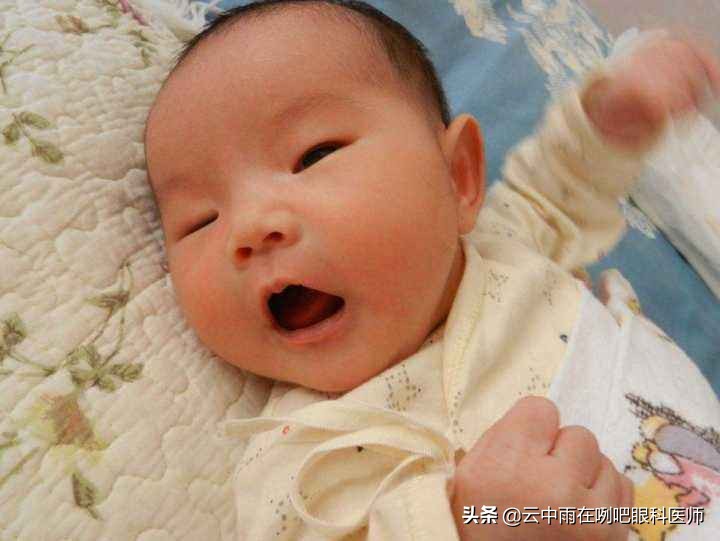 先天性眼睛上睑下垂严重怎么治疗,先天性上睑下垂恢复