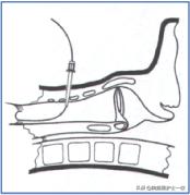 干货：气管切开术及护理措施