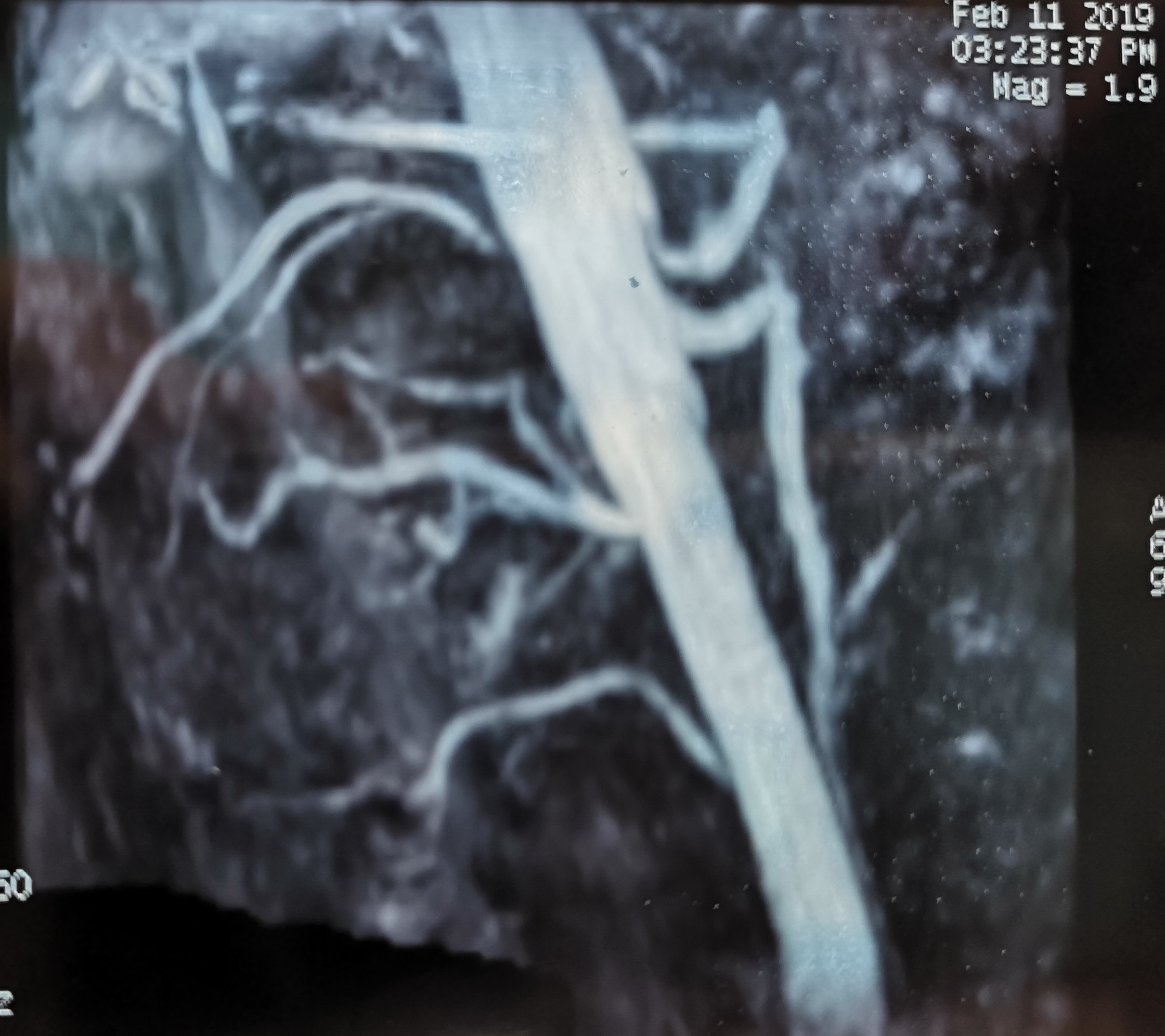 胆囊萎缩会引起进食后腹痛,进食腹痛和进食后腹痛