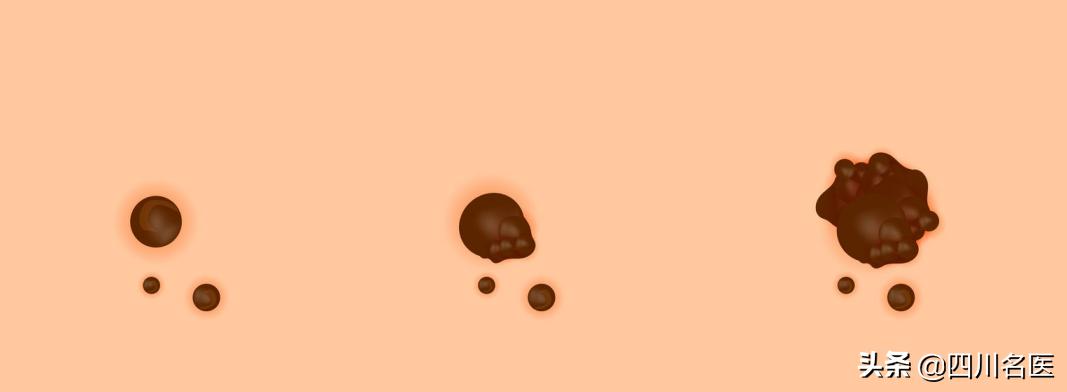 肉痣在癌变之前切除,凸起的黑色痣会癌变会怎样