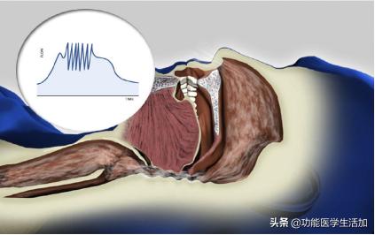 我打鼾鼾声如雷怎么治疗,打鼾声如雷咋治