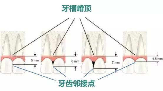 牙龈上有白色的牙垢刷不掉,牙龈里的黑东西