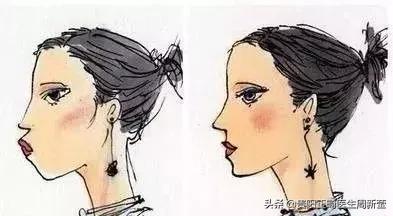 龅牙牙齿不齐戴透明牙套能矫正吗,矫正牙齿不齐后出现龅牙