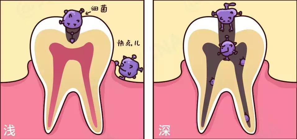 早起补牙能防蛀牙吗,早去补牙好处