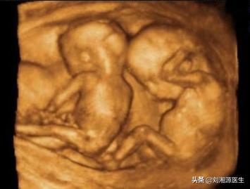 免疫性不良妊娠保胎成功,免疫治疗不良妊娠的方法