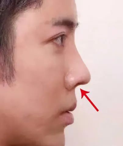先天鼻小柱内凹的原因,鼻小柱往里凹怎么办