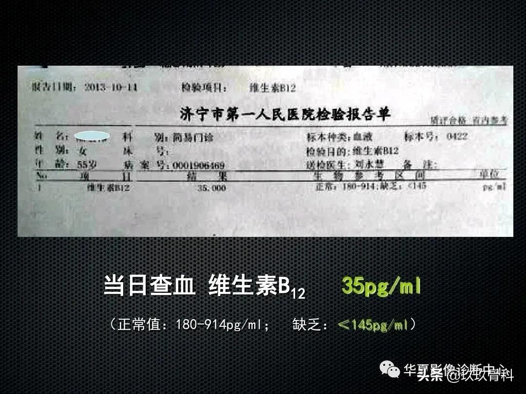 颈椎病脊髓变性mri表现,脊髓亚急性联合变性的诊断