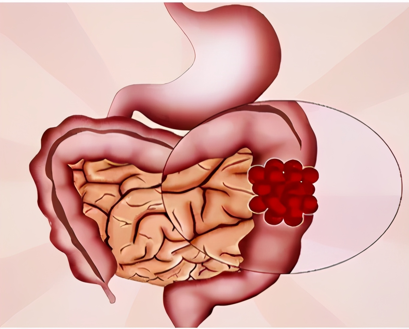 肠癌手术吻合口隆起复发,肠癌手术后再次复发还能治好吗