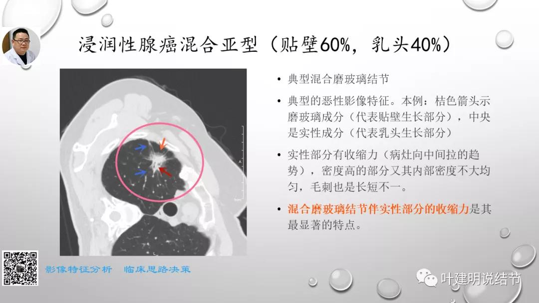 叶建明谈肺实性小结节视频,廖正银教授谈肺结节