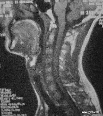 中医治疗多发性硬化的成功病例,今日病例