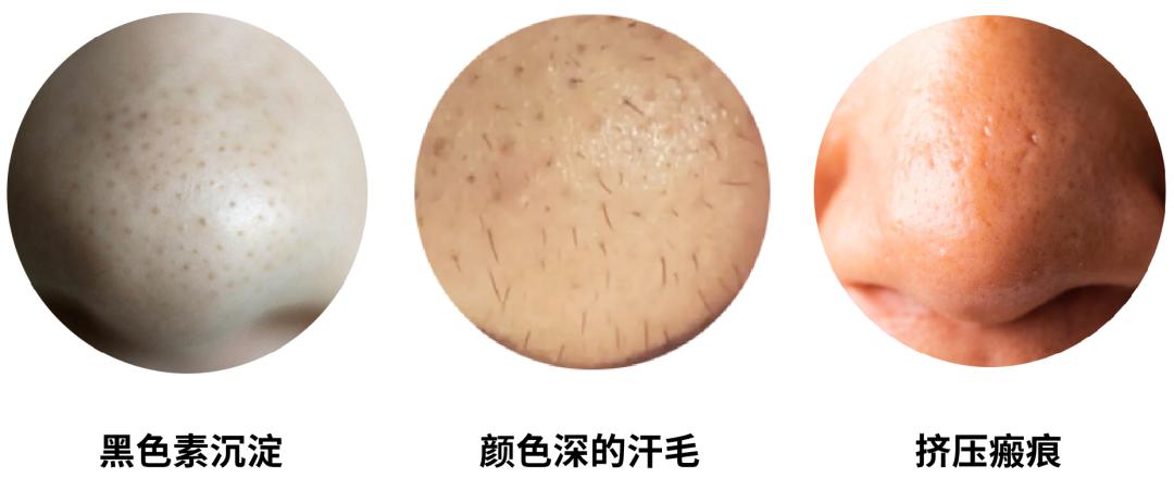 黑头毛孔粗大到底怎么治,黑头毛孔粗大有没有必要去改善