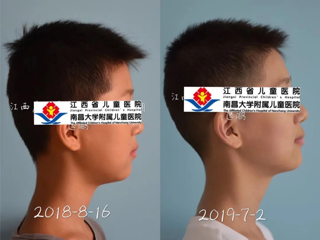 有没有办法把长歪的牙齿矫正,成年牙齿歪了怎么矫正大概要多久