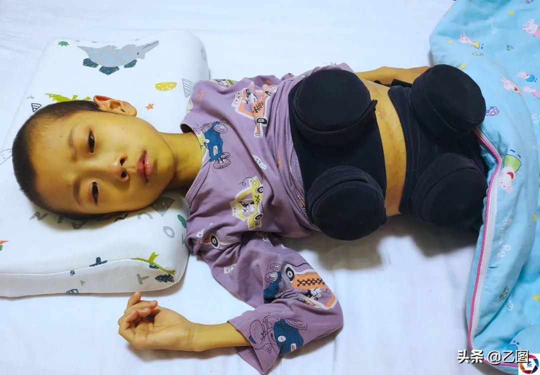 孩子四年经历三次手术,男孩4次开腹手术