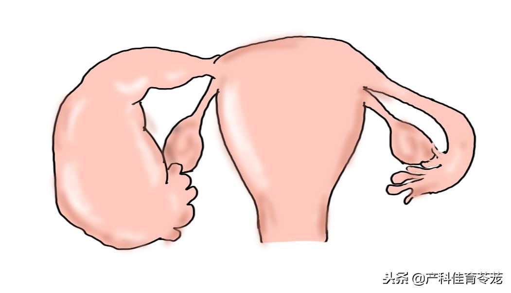 b超提示输卵管有积液,b超输卵管造影后为什么盆腔积水