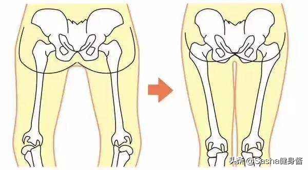 严重o型腿怎么矫正最有效的动作,正确矫正o型腿的方法