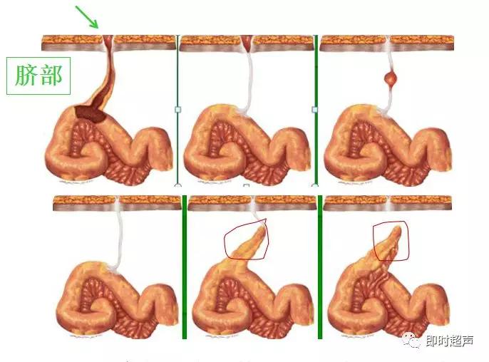 小儿消化道急症超声