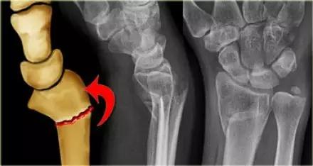 特殊骨折类型,特殊骨折体征