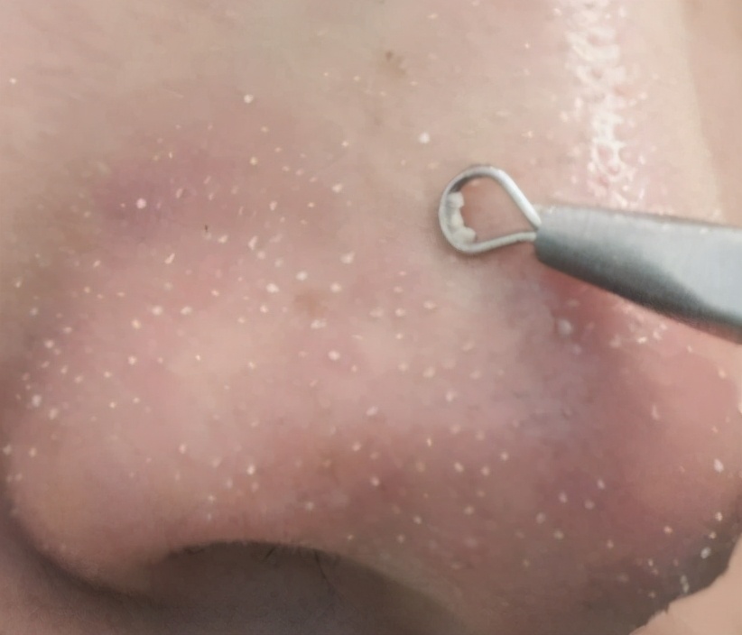 黑头自己从毛孔里自己出来了咋办?