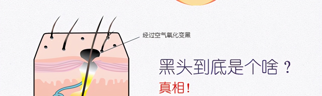 激光祛黑头粉刺需要多少钱,激光祛黑头真的可以去除吗