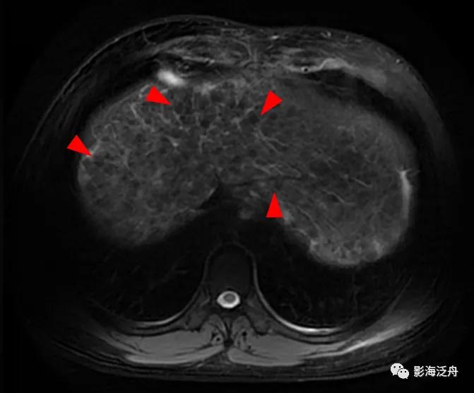肝脏弥漫性病变严重吗,肝脏弥漫性的病变的症状