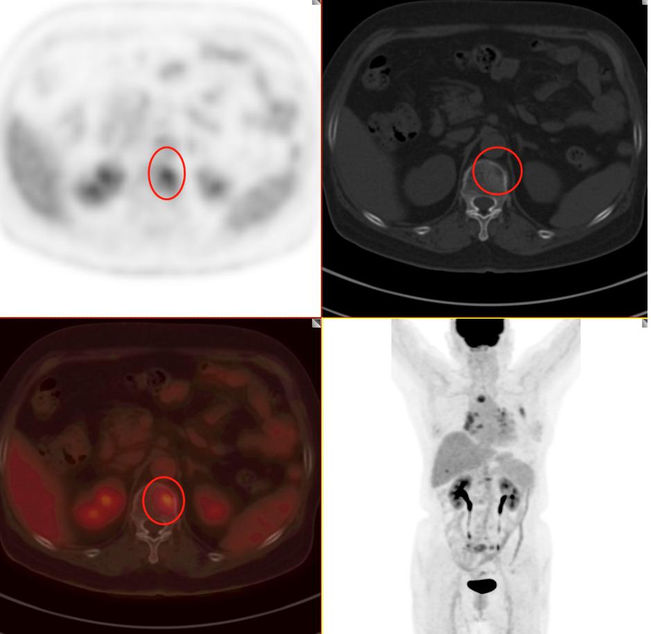 肺结节检查是薄层ct还是三维重建,肺结节检查用什么ct