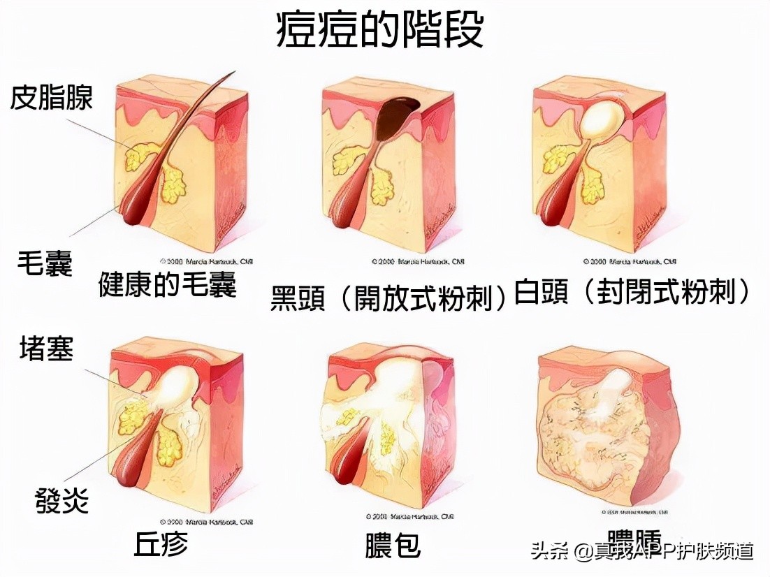 毛孔粗大黑头多脸爱出油怎么解决,毛孔粗大有黑头适合用什么洗面奶