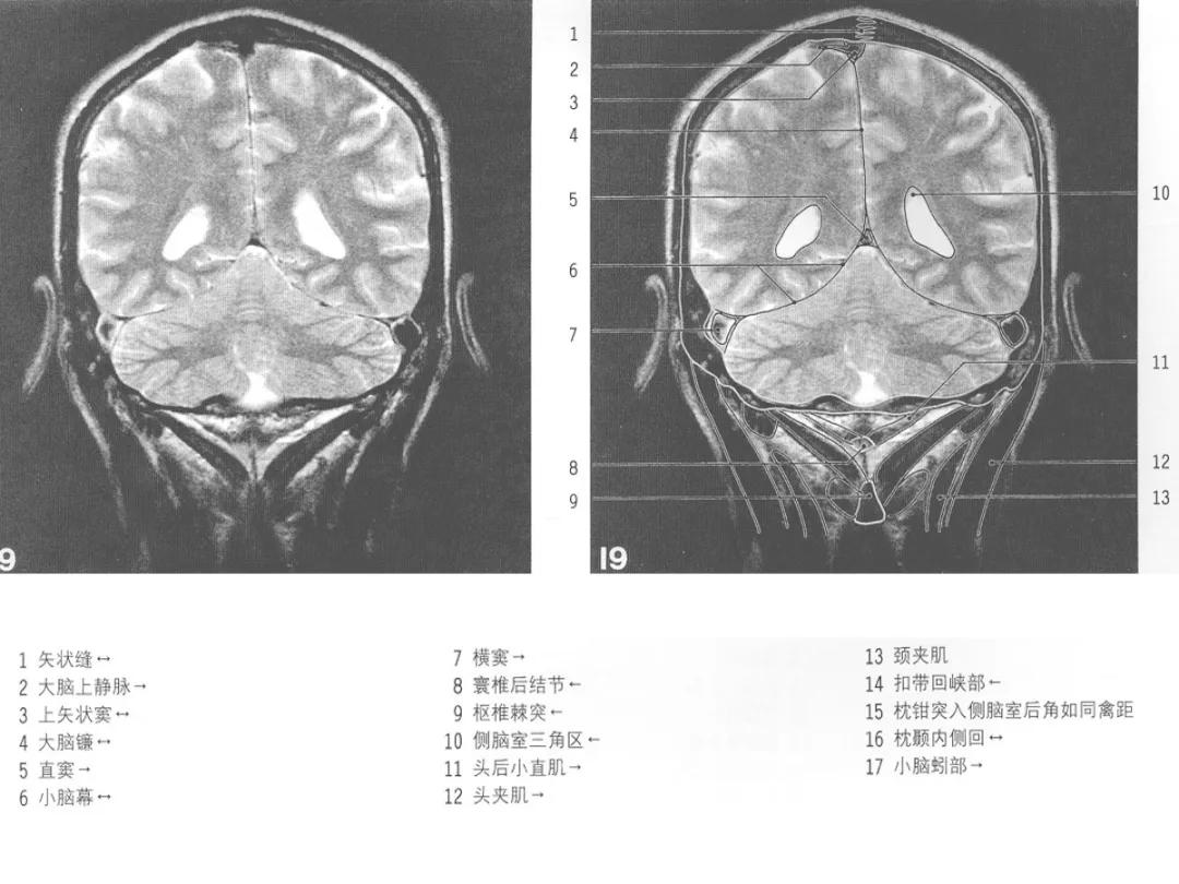颅脑冠状状切面解剖图,颅脑mr解剖结构图