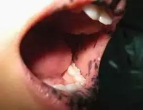 嘴唇黑斑是黑斑息肉综合症吗,黑斑息肉病建议要孩子吗