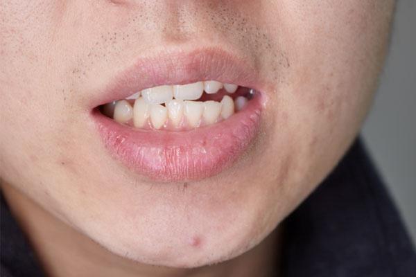 整牙堪比换头,整牙堪比整容真人案例