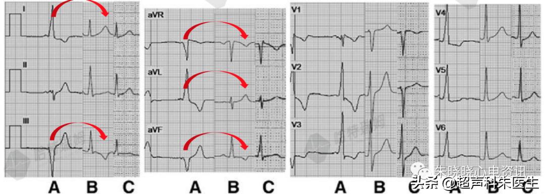 t波倒置诊断,t波倒置如何区分严重程度