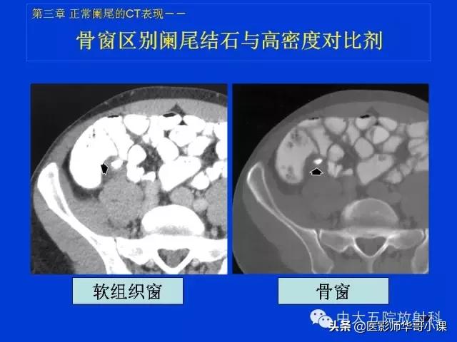 阑尾炎课件,阑尾炎的超声课件