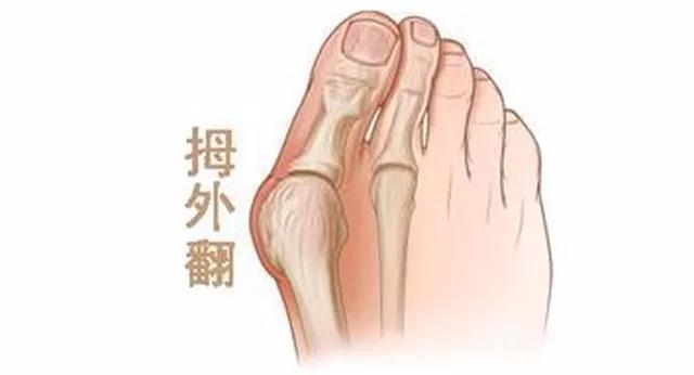 什么叫做拇外翻,什么是拇骨外翻