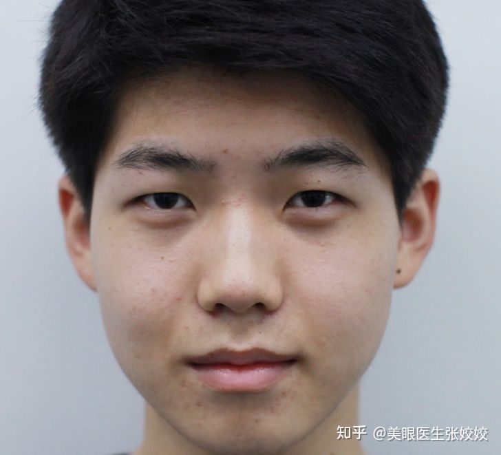 男生双眼皮手术前后对比,男生做双眼皮手术的效果
