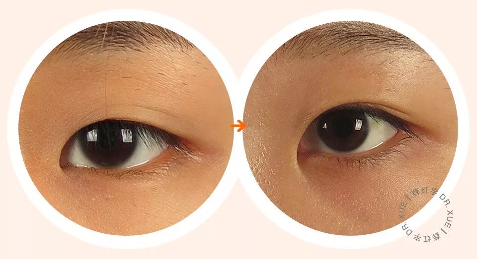 从美术角度谈眯眯眼,开内眼角传统术式