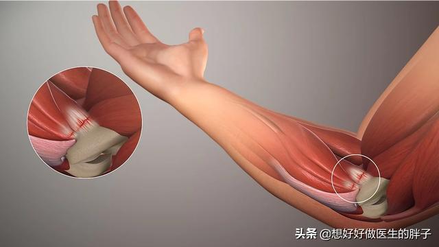 胳膊用力过度后胳膊肘疼怎么回事,胳膊肘劳累过度关节疼痛用什么药
