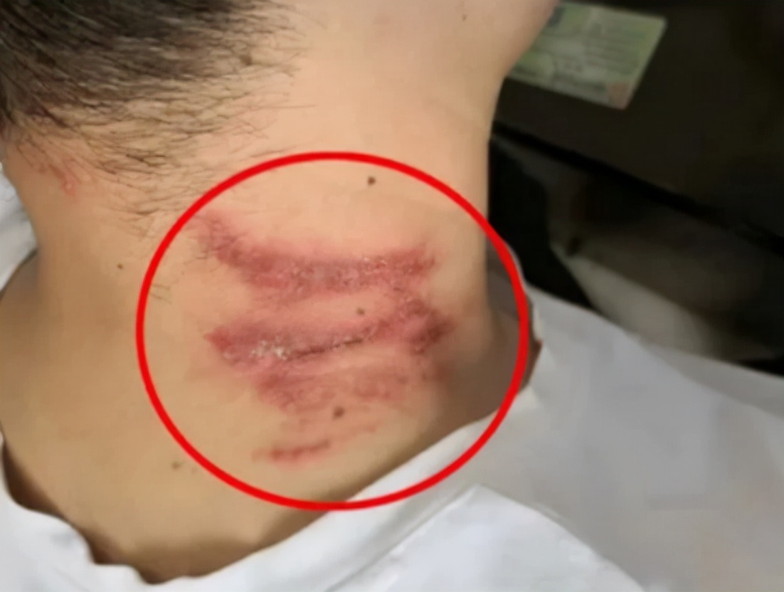 被隐翅虫毒液沾到涂什么药膏,被隐翅虫咬伤特效药