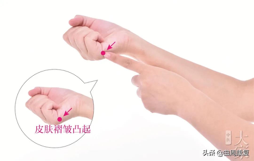 一针透两穴治愈落枕医案,针灸治疗落枕有奇效