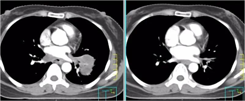 免疫疗法治鳞癌是可单独实施吗,肺转移性鳞癌免疫组化