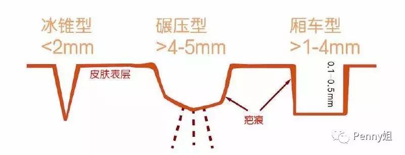 如何有效去除痘印痘痘,治疗痘印痘疤费用