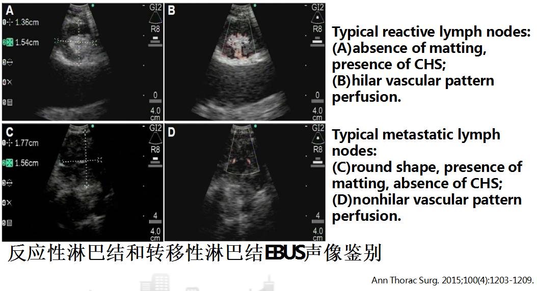 小细胞肺癌的气管镜介入治疗,导航支气管镜在肺癌诊断中的应用