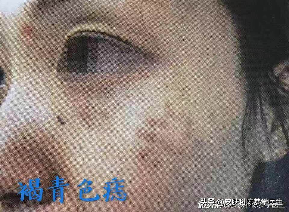 色斑的种类及治疗,色斑属于常见的什么皮肤问题