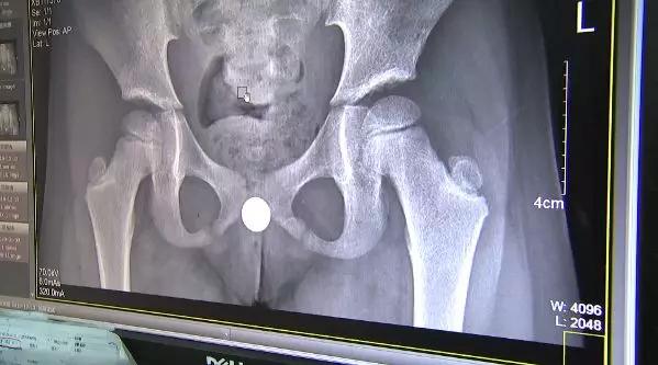 小孩鼻子塞进异物出血怎么处理,小孩耳朵塞进异物流血